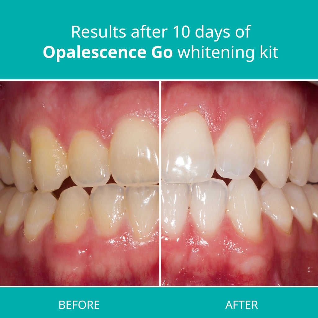 Opalescence Go™ Prefilled Teeth Whitening Trays, Mint U85092